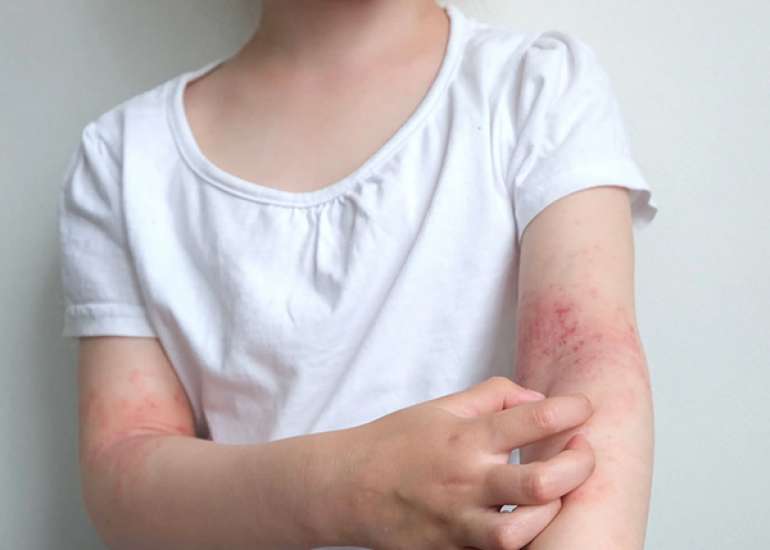 Childhood Atopic Dermatitis and Risk of Non-Atopic Comorbid Conditions